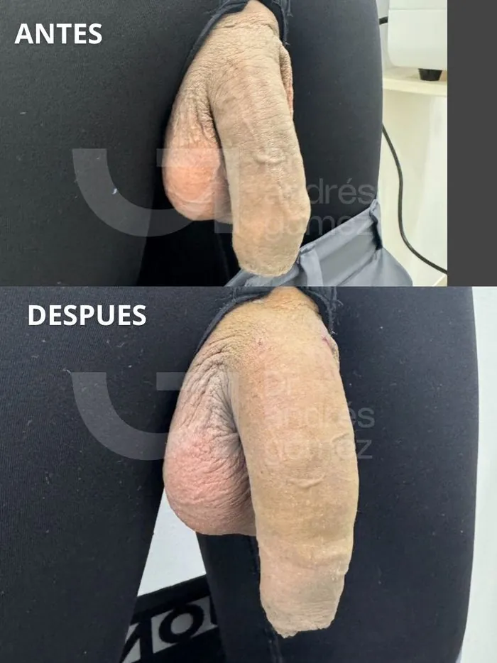 Caso 11 antes y después engrosamiento peneano MENFILL Madrid